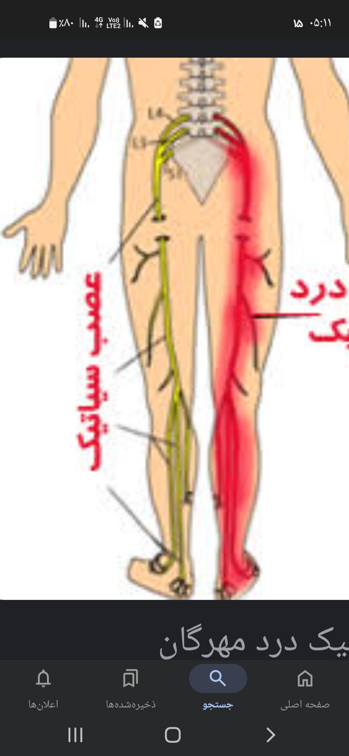 درمان کامل سیستم عصبی .سیاتیک
